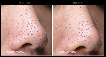 618搶瘋了！14天見證毛孔奇跡，黑頭徹底消失+肌膚測(cè)試儀實(shí)測(cè)解析